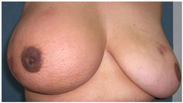 breast cancer 4Swelling-common-to-IBC
